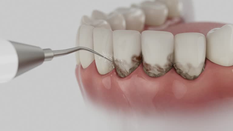 Reliable Dental Implants contractor in Edina, MO by Smile Center Dentistry